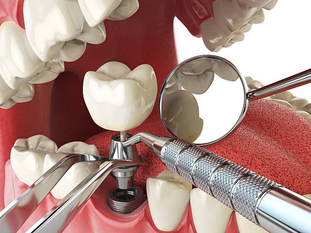 Best Emergency Dental Extractions in Folly Beach, SC